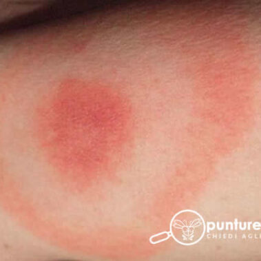Riconoscere le punture delle zecche molli del piccione