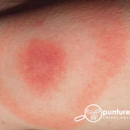 Riconoscere le punture delle zecche molli del piccione