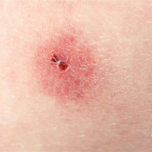 Riconoscere le punture delle zecche molli del piccione