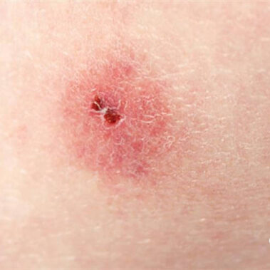 Punture e morsi zecche del piccione